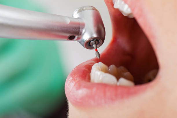 Best Knocked-Out Tooth (Avulsed Tooth) Treatment in Cheree, OK